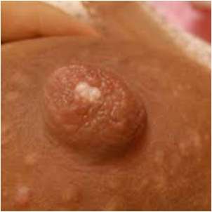 乳頭小白點的成因 乳頭小白點的成因