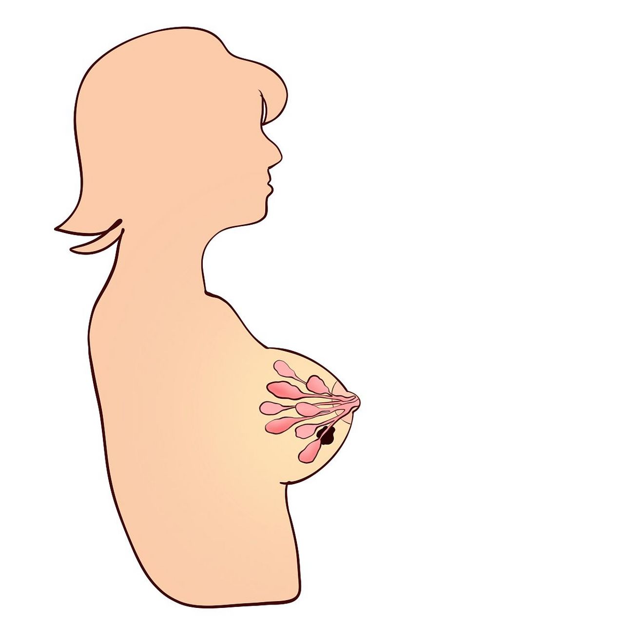 乳腺增生症狀 乳腺增生症狀