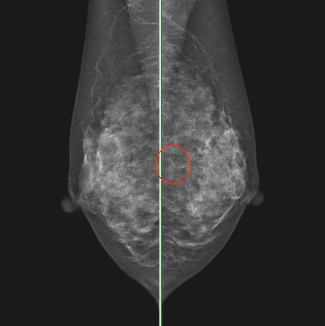乳房鈣化原因