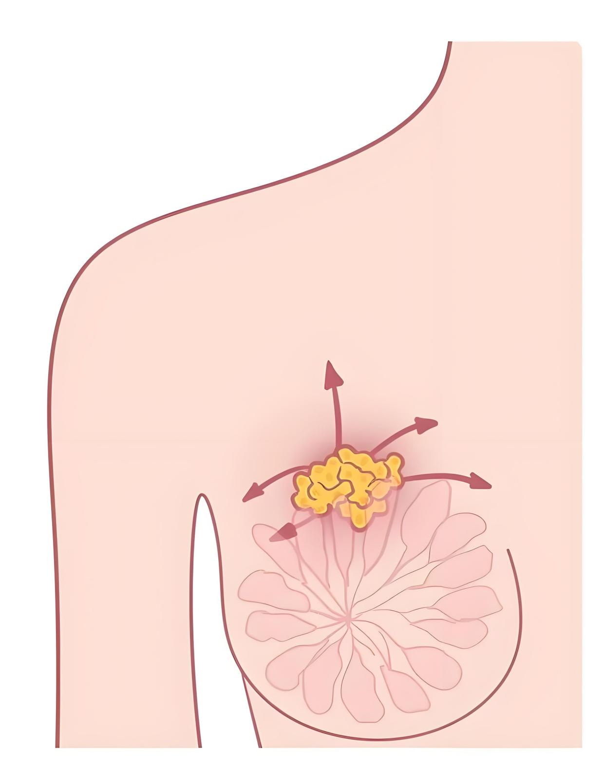乳腺增生症狀 乳腺增生症狀