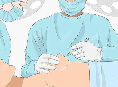 隆乳費用